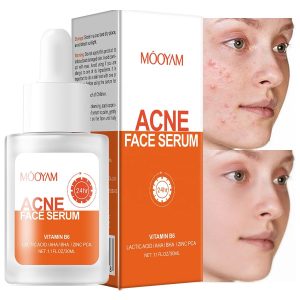 Remove Acne Face Serum – 24 Hours Visible Result