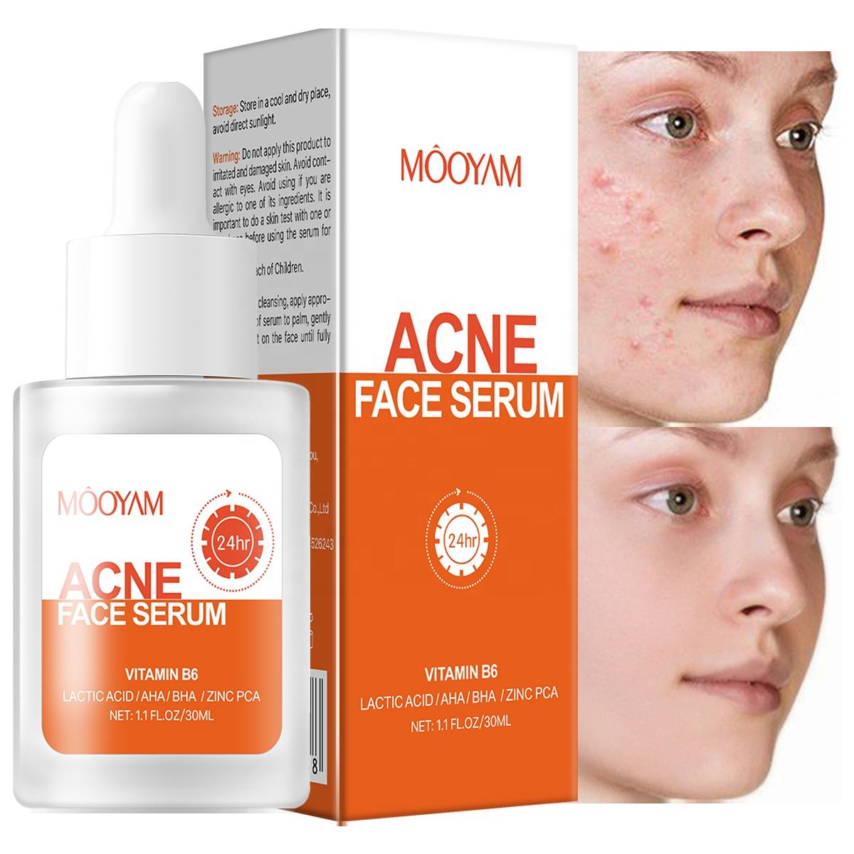 Remove Acne Face Serum – 24 Hours Visible Result